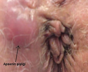Makat Apsesi Belirtileri ve Tedavisi