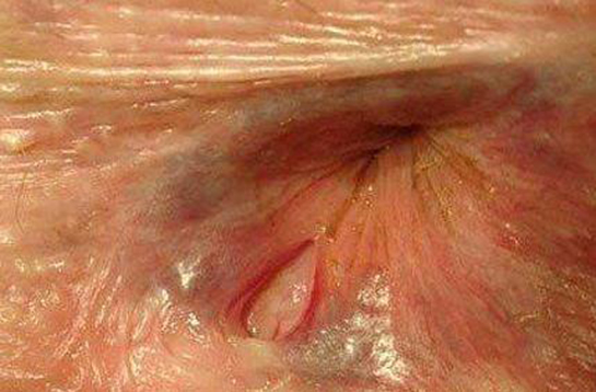 Makat Çatlağı Nasıl Geçer?