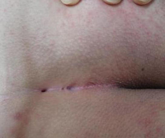 Makat Hastalıkları Belirtileri ve Tedavisi