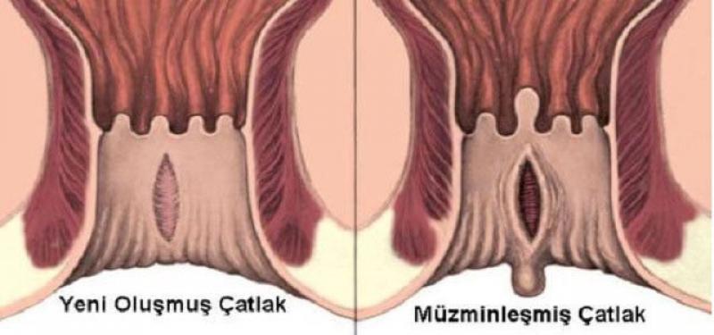 Makatta Yara Belirtileri ve Tedavisi